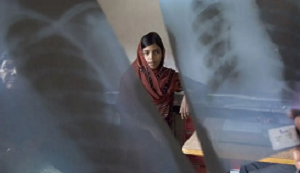 Tuberculosis: un viejo asesino invencible
