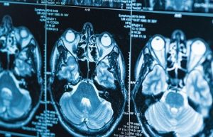 Mujeres víctimas de agresión sexual sufren cambios drásticos en el cerebro