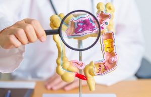Combinación de dos nutrientes multiplican defensa del colon contra el cáncer