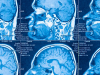 Identifican dos subtipos de autismo en el cerebro