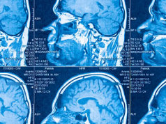Identifican dos subtipos de autismo en el cerebro